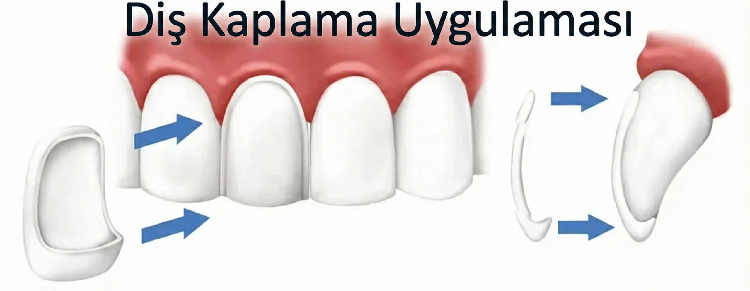 dis kaplama application