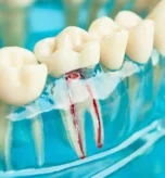 Bahçelievler Kanal Tedavisi