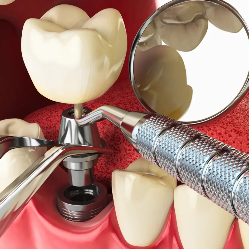 implant diş tedavisi