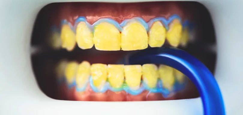 Dişlerim Sararıyor Ne Yapmalıyım