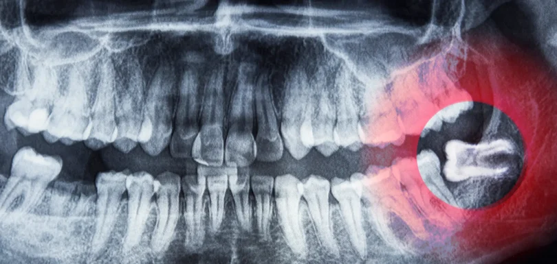 Gömülü 20’lik Diş