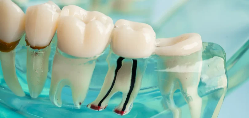 Kanal Tedavisi Sonrası Isırınca Ağrı Neden Olur