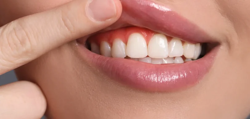 Sağlıklı Dişler İçin Dikkat Edilmesi Gerekenler