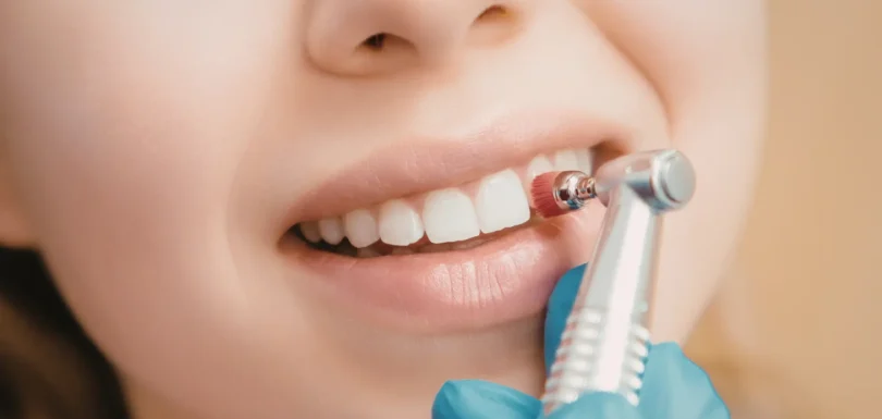 Kaplama Dişim Çıktı